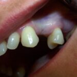 Przed implantacją - brak zęba 24